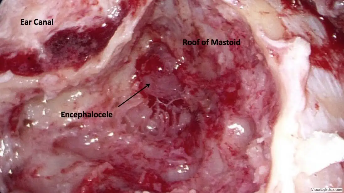 Encephalocele Cerebrospinal Fluid Leaks of the Ear 