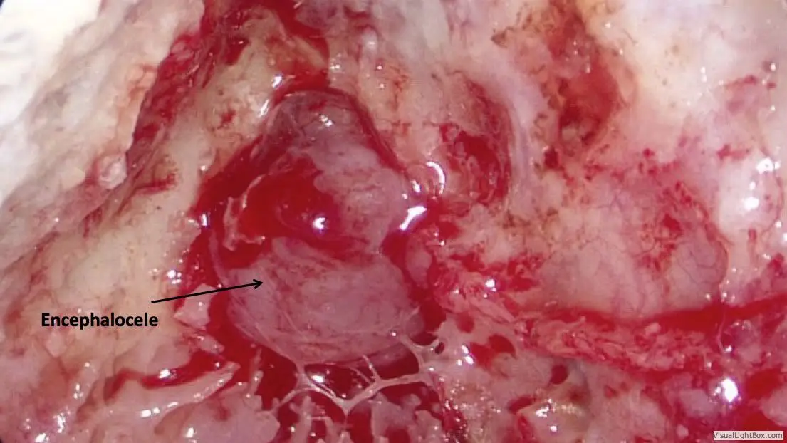 Encephalocele Cerebrospinal Fluid Leaks of the Ear 