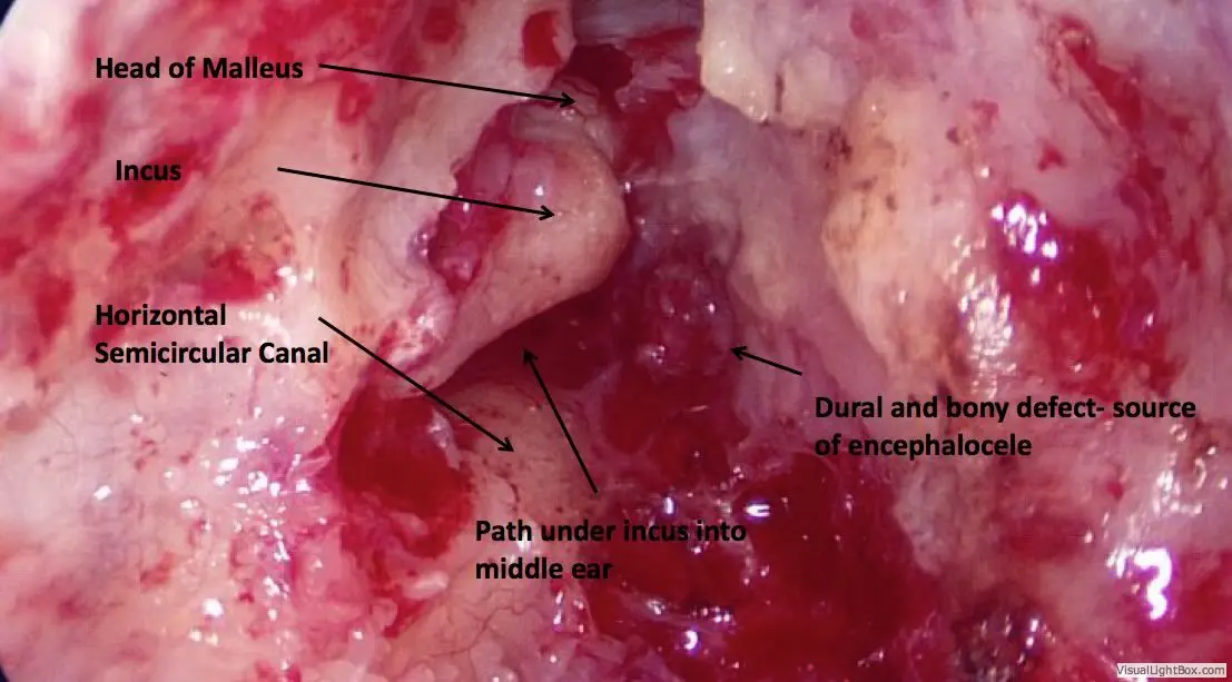 Encephalocele Cerebrospinal Fluid Leaks of the Ear 