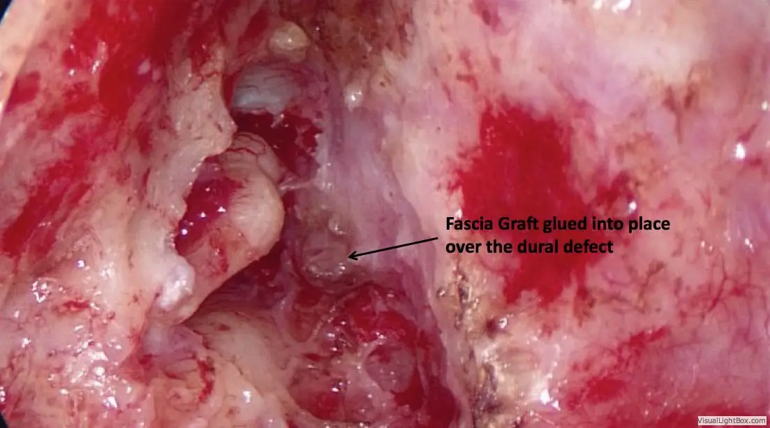 Encephalocele Cerebrospinal Fluid Leaks of the Ear 