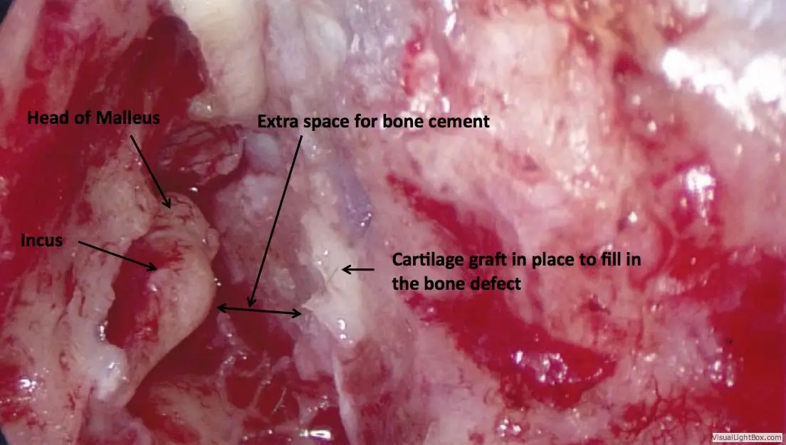 Encephalocele Cerebrospinal Fluid Leaks of the Ear 