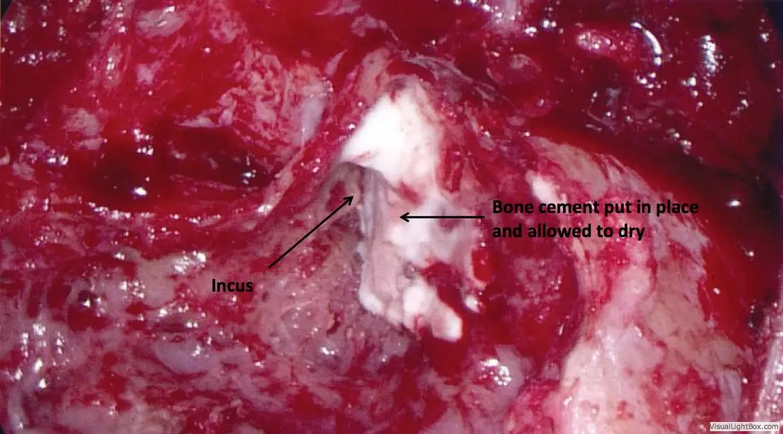 Encephalocele Cerebrospinal Fluid Leaks of the Ear 