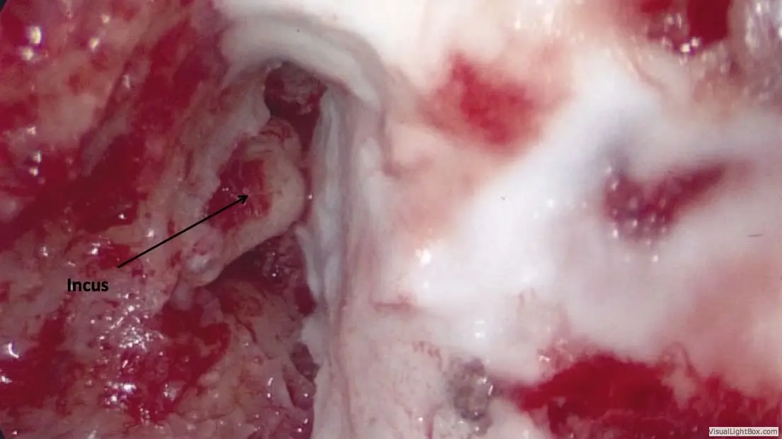 Encephalocele Cerebrospinal Fluid Leaks of the Ear 