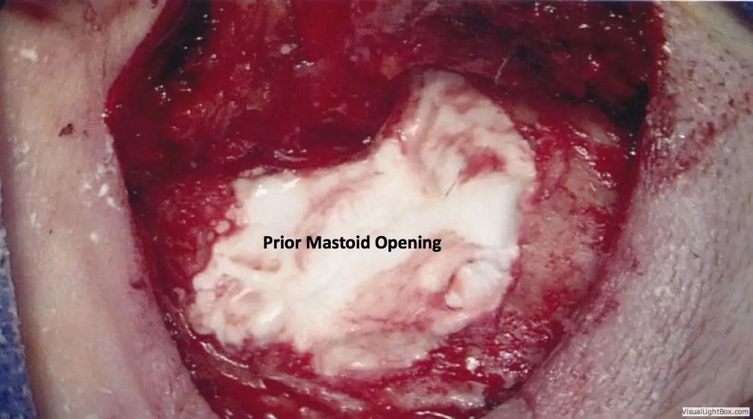 Encephalocele Cerebrospinal Fluid Leaks of the Ear 