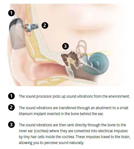 Bone Anchored Hearing System