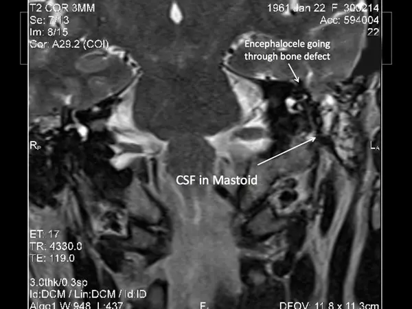 Encephalocele Cerebrospinal Fluid Leaks of the Ear 