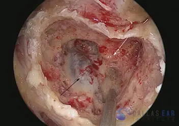 Endolymphatic Sac Surgery Cases