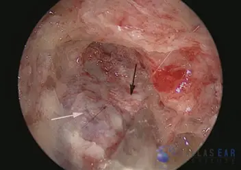 Endolymphatic Sac Surgery Cases