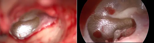 Endoscopic Ear Surgery