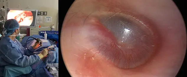 Endoscopic Ear Surgery