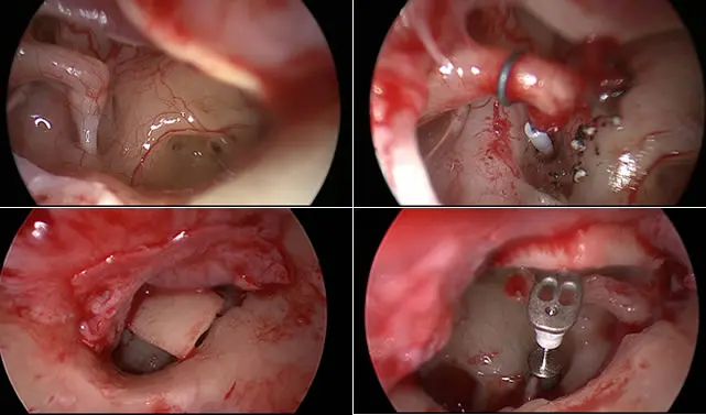 Endoscopic Ear Surgery