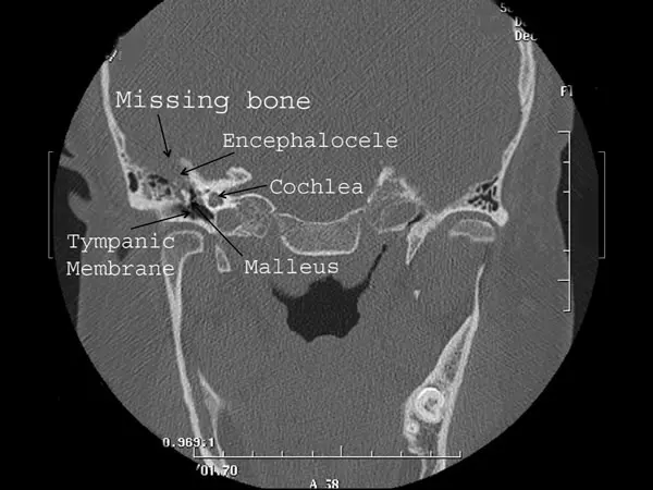 Encephalocele Cerebrospinal Fluid Leaks of the Ear 