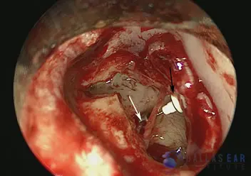 Temporal Bone Trauma Cases