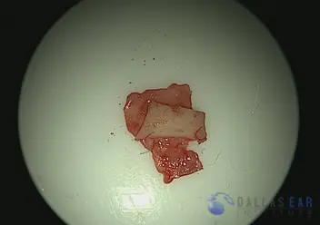 Temporal Bone Trauma Cases