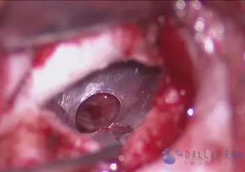 Tympanoplasty