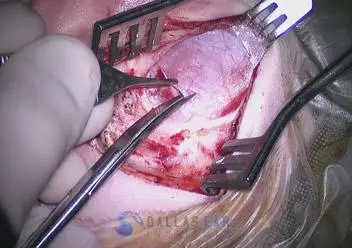 Tympanoplasty