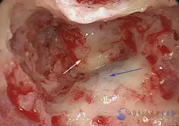 Posterior Semicircular Canal Occlusion