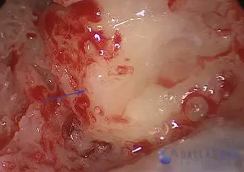 Posterior Semicircular Canal Occlusion