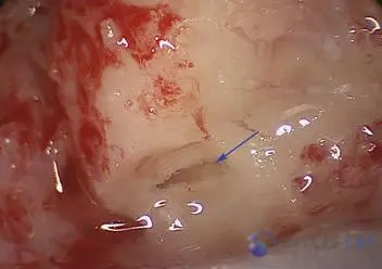 Posterior Semicircular Canal Occlusion