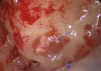 Posterior Semicircular Canal Occlusion