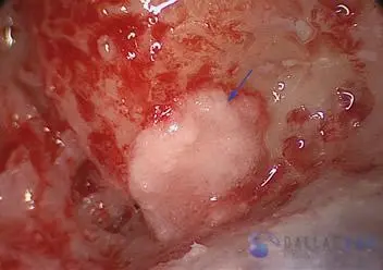 Posterior Semicircular Canal Occlusion