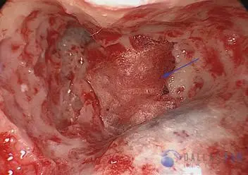 Posterior Semicircular Canal Occlusion