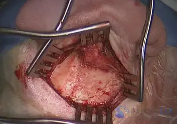 Superior Semicircular Canal Dehiscence (SSCD)