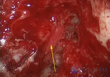 Superior Semicircular Canal Dehiscence (SSCD)