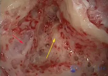 Superior Semicircular Canal Dehiscence (SSCD)