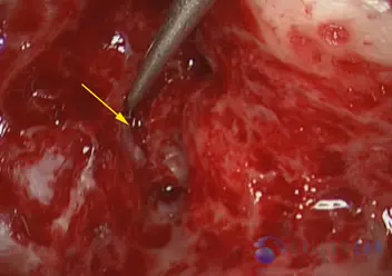 Superior Semicircular Canal Dehiscence (SSCD)