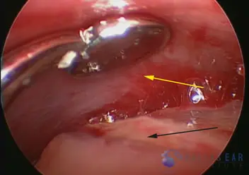 Superior Semicircular Canal Dehiscence (SSCD)