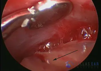 Superior Semicircular Canal Dehiscence (SSCD)