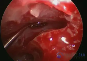 Superior Semicircular Canal Dehiscence (SSCD)