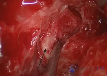 Superior Semicircular Canal Dehiscence (SSCD)