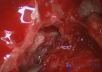 Superior Semicircular Canal Dehiscence (SSCD)