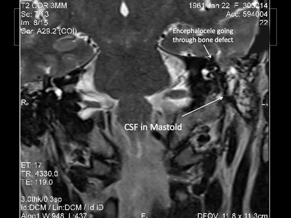 csf-in-mastoid