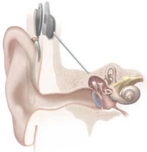 Cochlear implant.