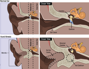 diagram of ear surgery.