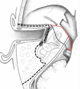 diagram of resection of the ear.