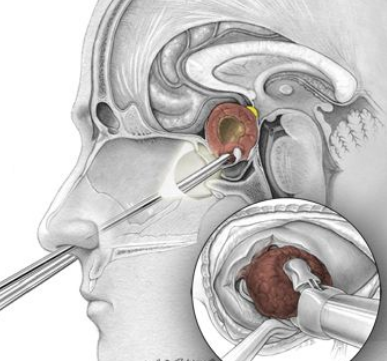 diagram of the cholesterol granuloma surgery.