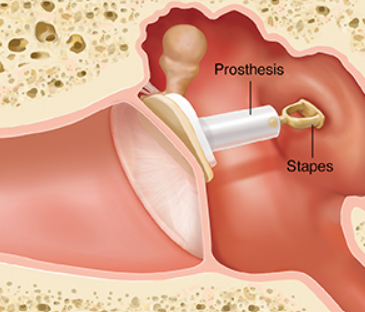 Diagram of ear drum.