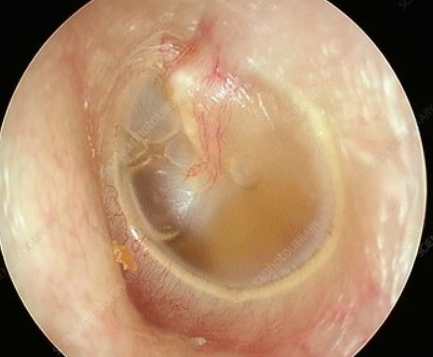 Image of ear drum.