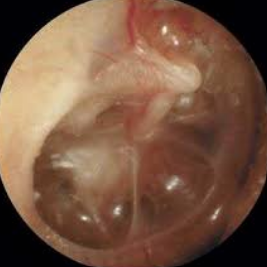 Infected ear drum.