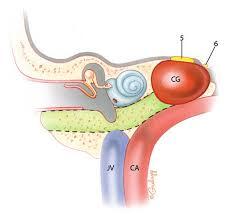 infracochlear approach.