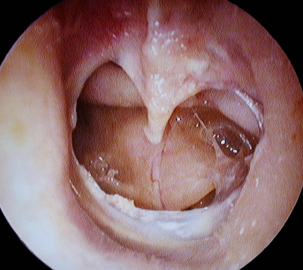 Middle ear collapse.