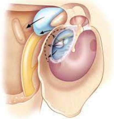 Repairing ear drum.