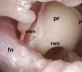 Scan of the inner ear.