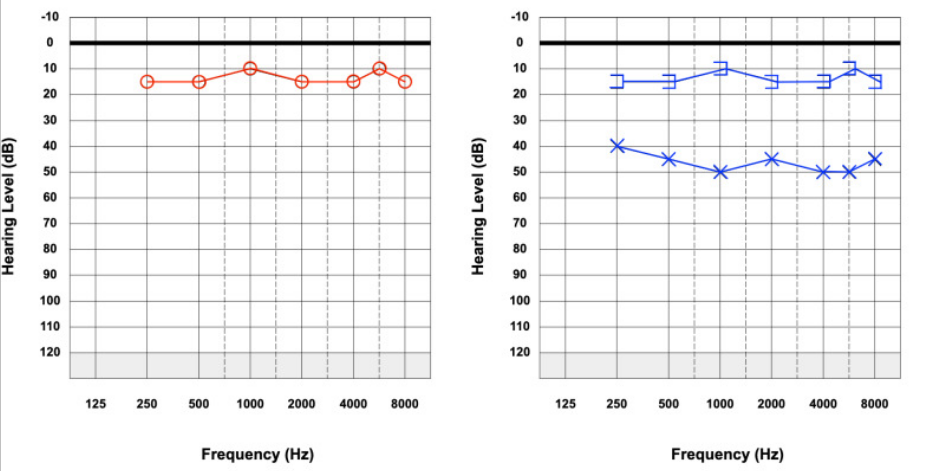 Conductive hearing loss graphs.