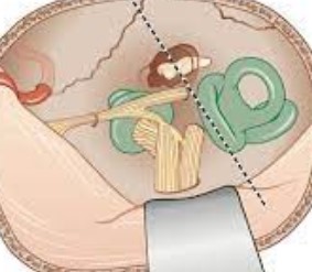 Diagram of a facial nerve surgery.