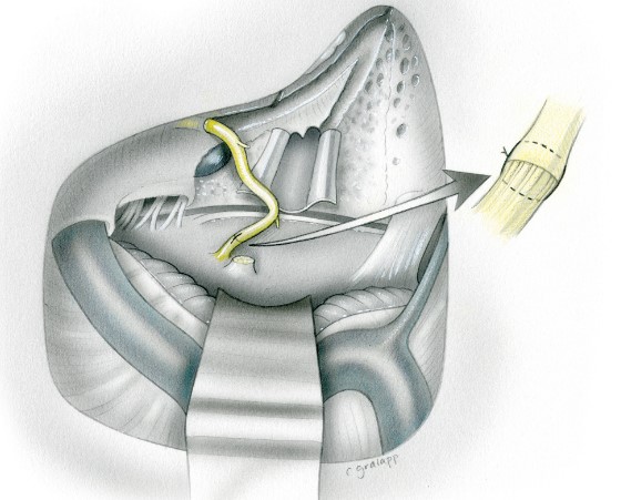 Diagram of facial surgery.